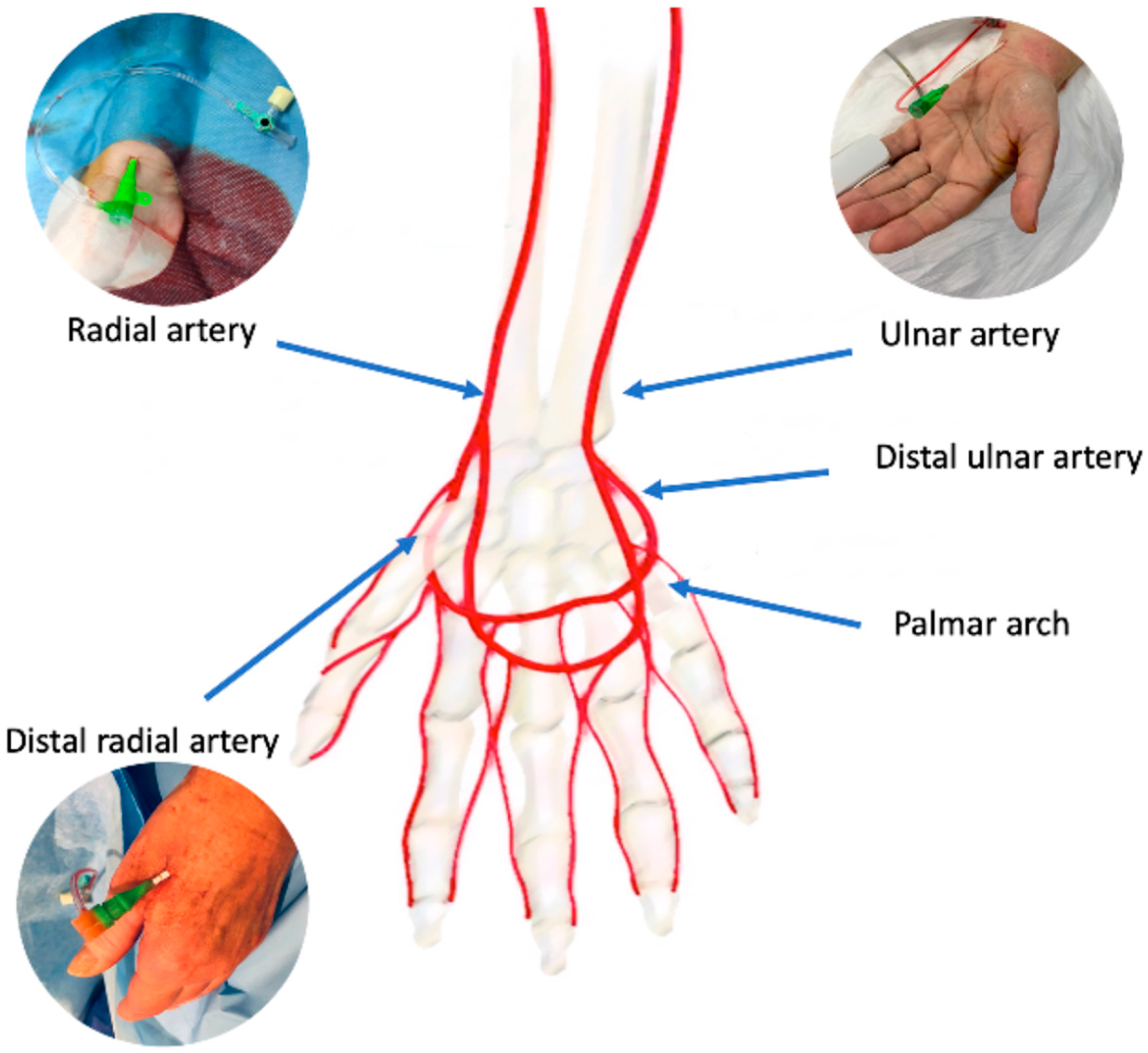 Understanding Angiograms: Femoral, Radial, and Ulnar Approaches - Dr ...