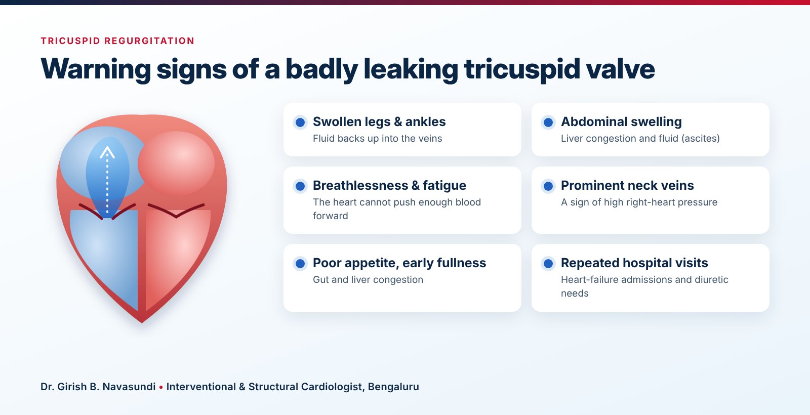 Warning signs of severe tricuspid regurgitation: swollen legs, abdominal swelling, breathlessness and fatigue, prominent neck veins, poor appetite and repeated hospital visits